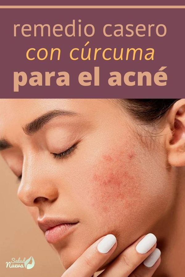 Remedio casero de cúrcuma para el acné 2 (1)