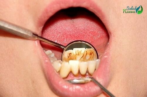 remedios naturales para quitar el sarro de los dientes