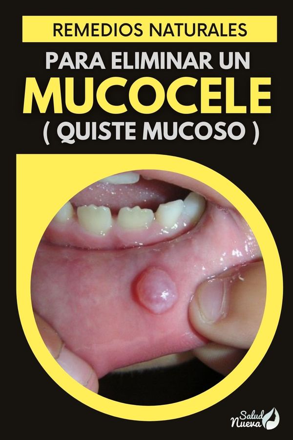 como eliminar un mucocele con remedios caseros