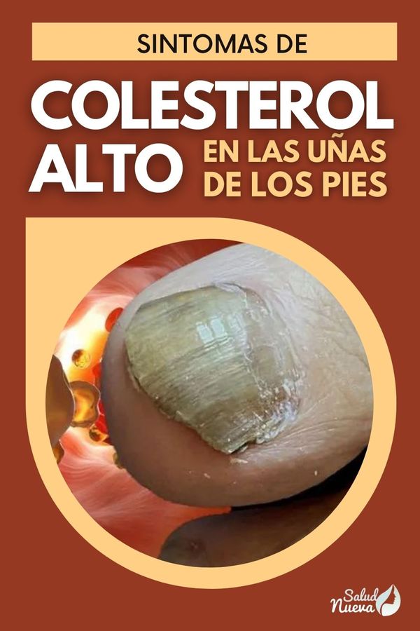 signos de colesterol alto en las uñas de los pies